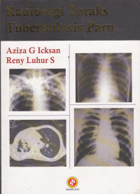 Image of Radiologi Toraks Tuberkulosis Paru
